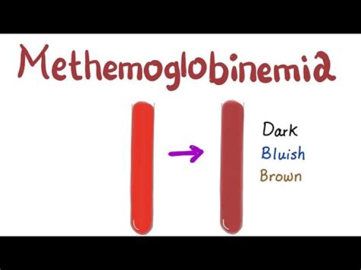 
What is methemoglobinemia? Beth Matthews inquest injuries explored 