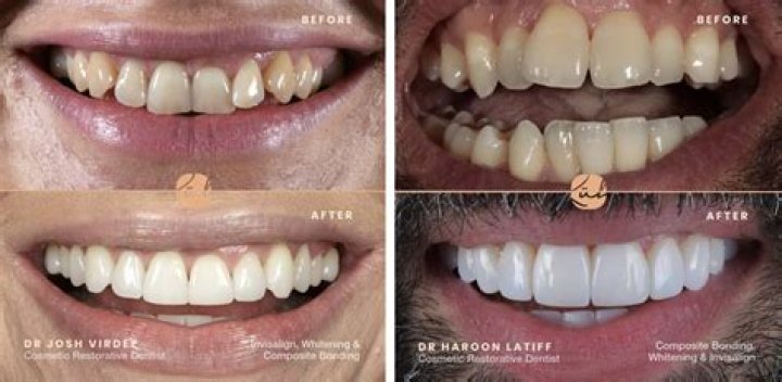 
What Is Wrong With Jamal Murray Teeth? Before And After Photo 